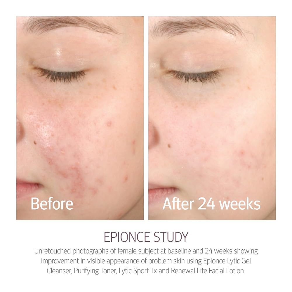 Epionce Renewal Lite Facial Lotion Lightweight Anti-Aging Face Moisturizer